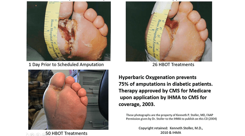 Before and after HBOT treatment images of a person with diabetic foot ulcers