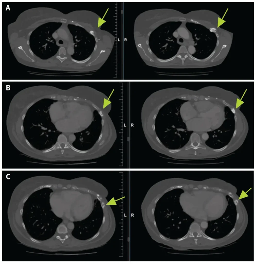 Computed tomography (CT) scan of the chest in a 62-year-old woman, showing healing of radiation-induced rib fractures from osteoradionecrosis after left-sided breast radiotherapy. Increased healing of left-sided (A) third, (B) fifth, and (C) seventh ribs. Baseline (left) and 11-month follow-up (right) CT scans of the chest are shown.